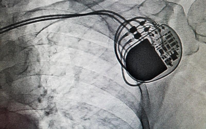 playing paintball with a pacemaker