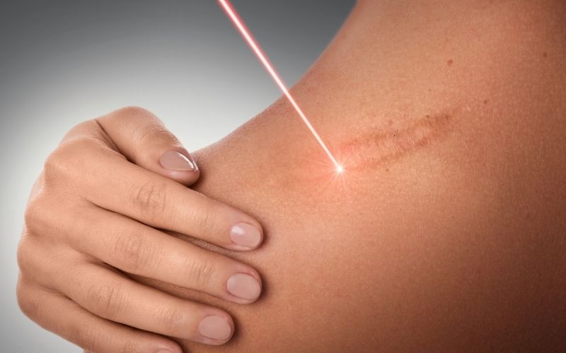 laser scar removal